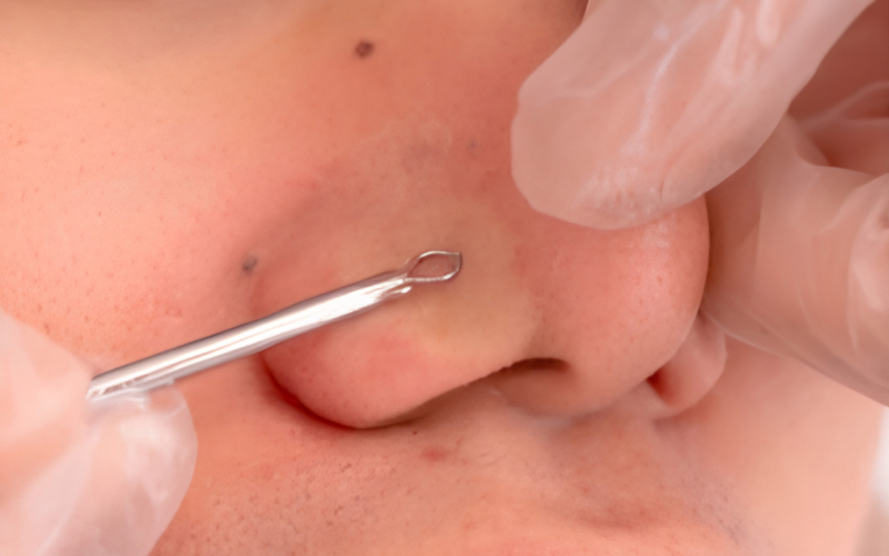 Clarifying Acne Facial